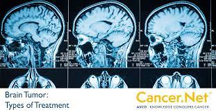 Understanding and Managing Brain Tumors